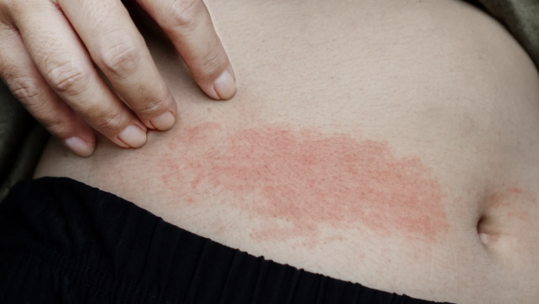 Dermatology Evaluation for Chronic Hives and Skin Allergies Near McLean, VA